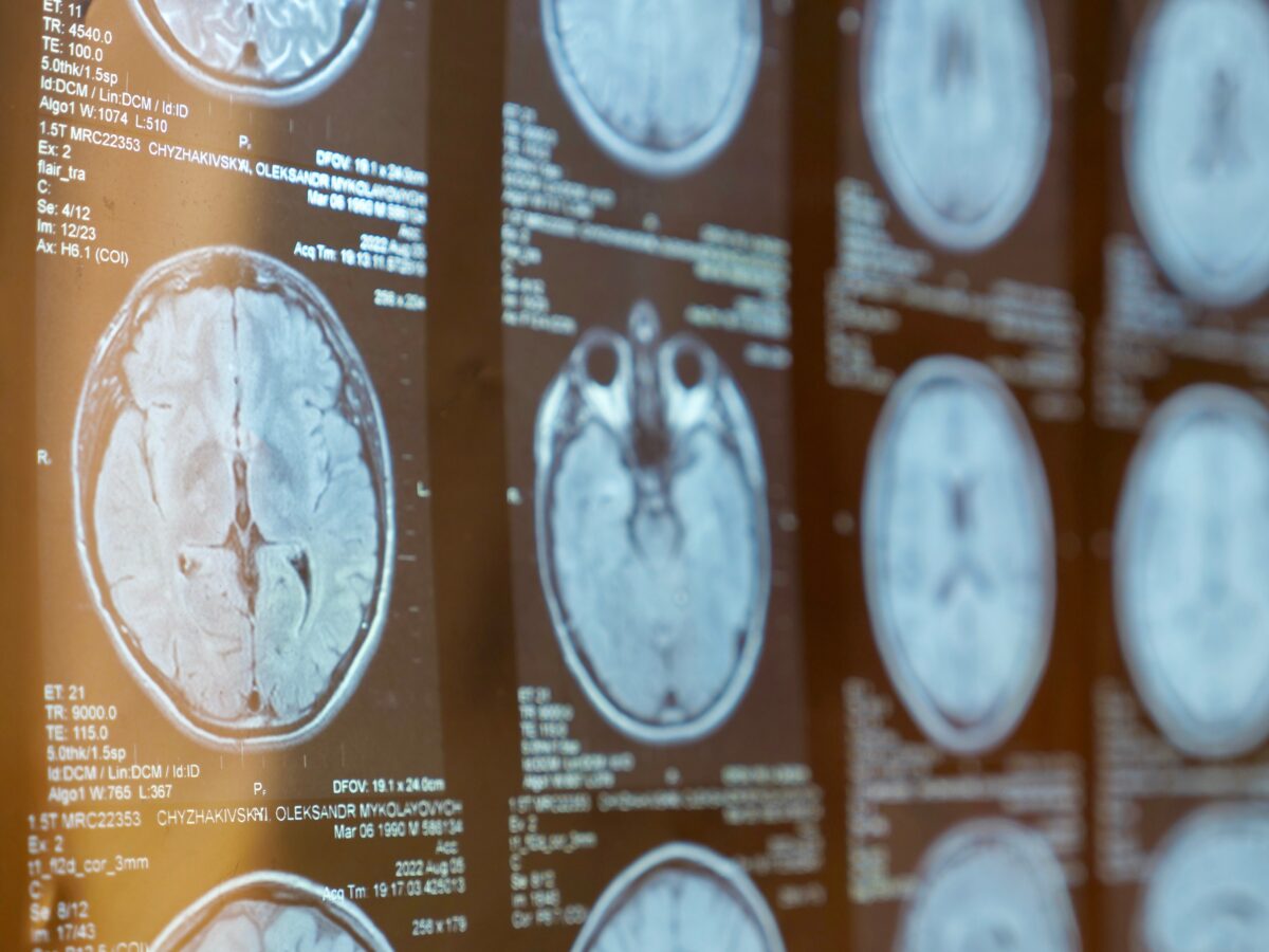 Examples of traumatic brain injuries in Spokane displayed on brain MRI scans