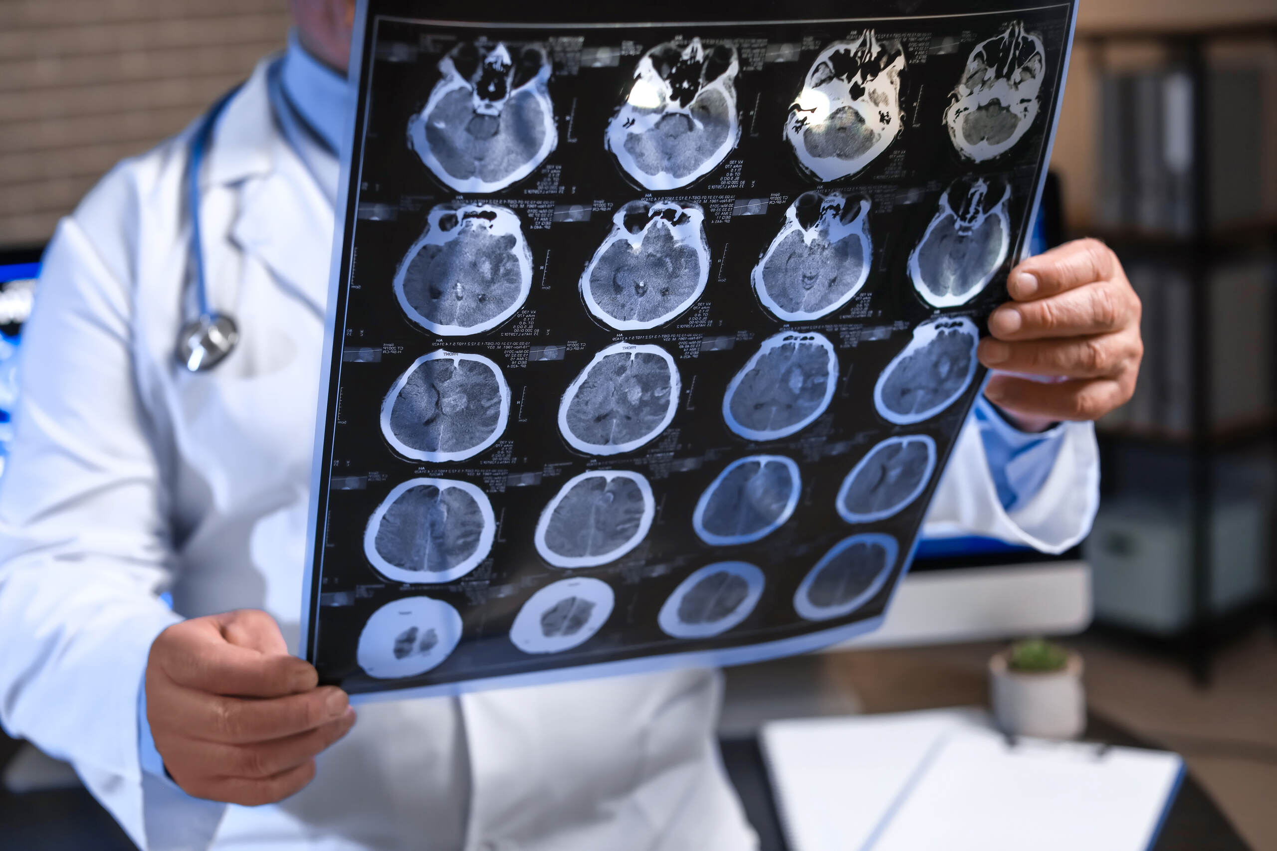 Doctor reviewing standard neuroimaging results in Spokane, illustrating why normal scans don't show microscopic cellular damage or concussions.